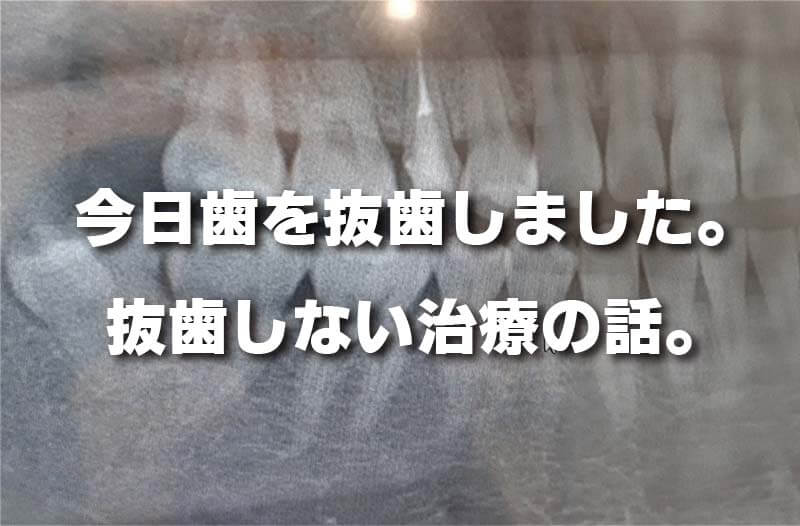 今日歯を抜歯しました。 抜歯しない治療の話。